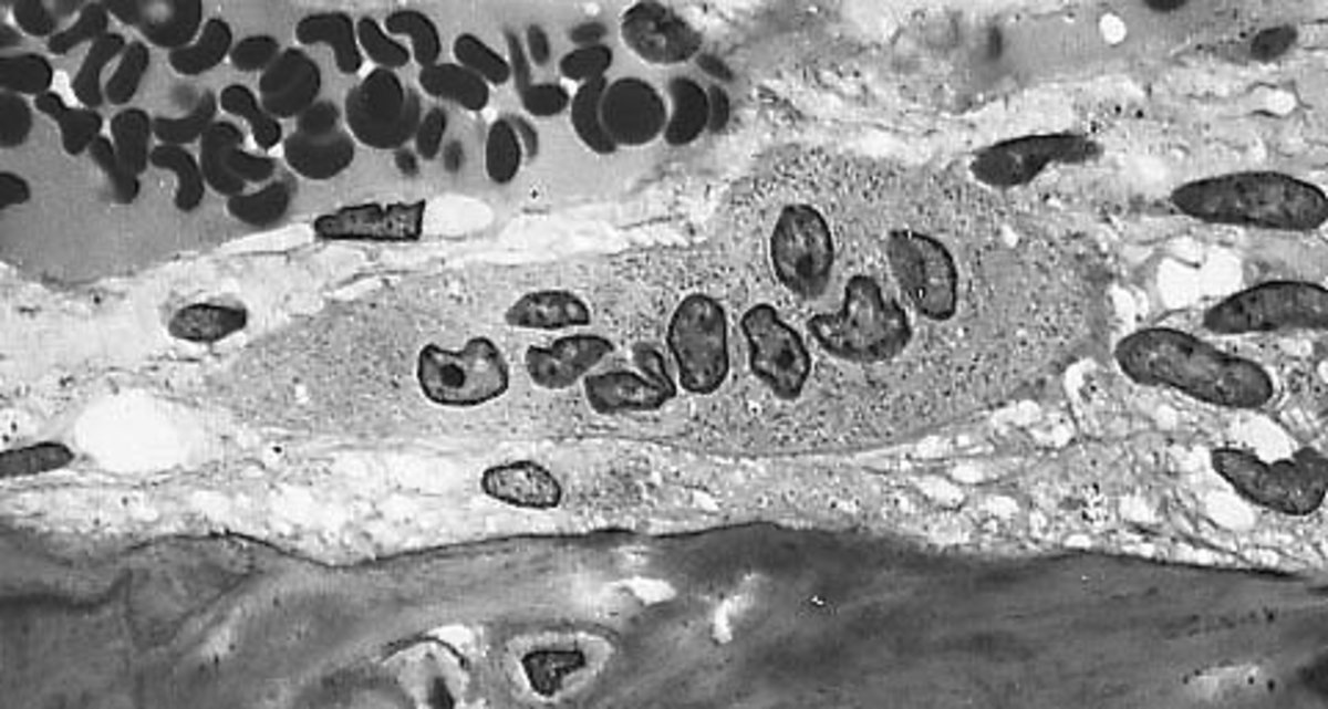 An osteoclast with multiple nuclei lying on top of bone. The cytosol (solution around the nuclei) has a typical "foamy" appearance.