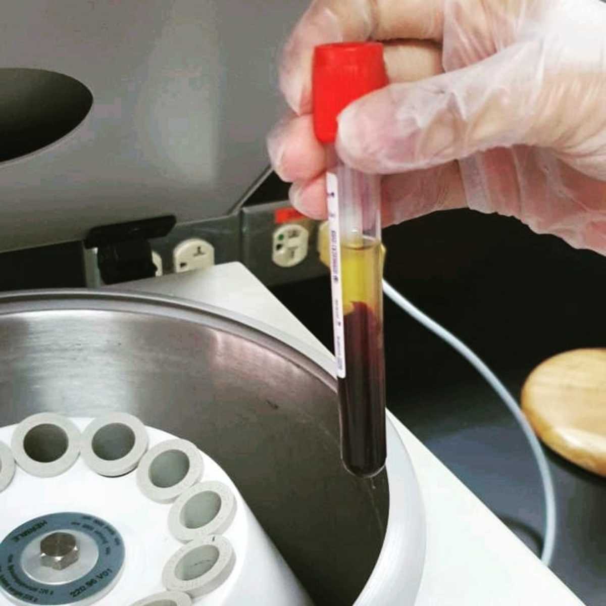 Serum immediately after centrifugation. In this, gel separator is not used hence you don't see a gel layer in the middle.