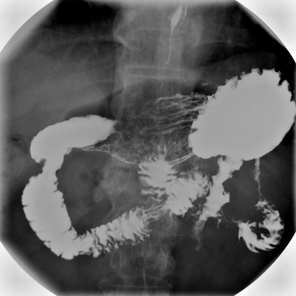 This is a radiocontrast x-ray of the stomach done using barium meal (or a "barium swallow").