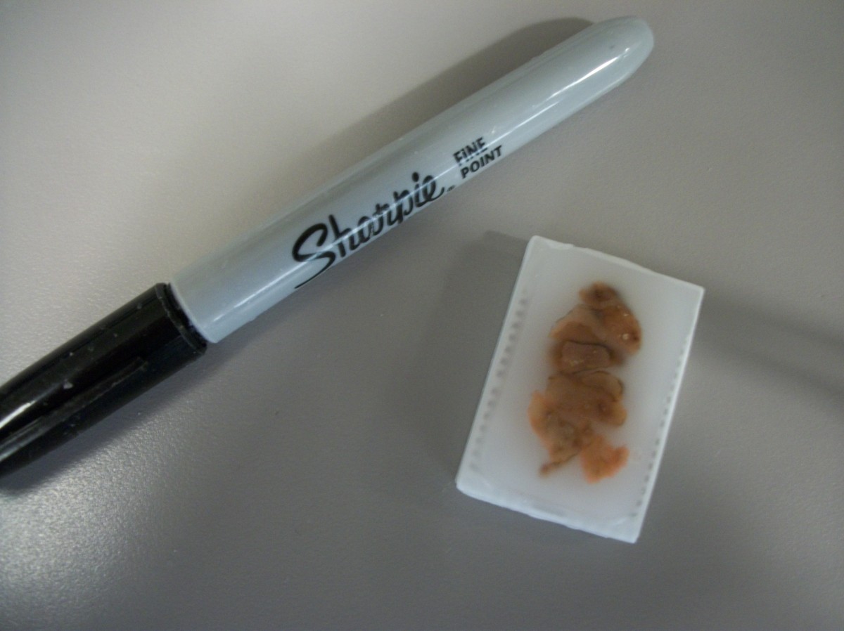 What Happens to a Biopsy After Surgery? Owlcation