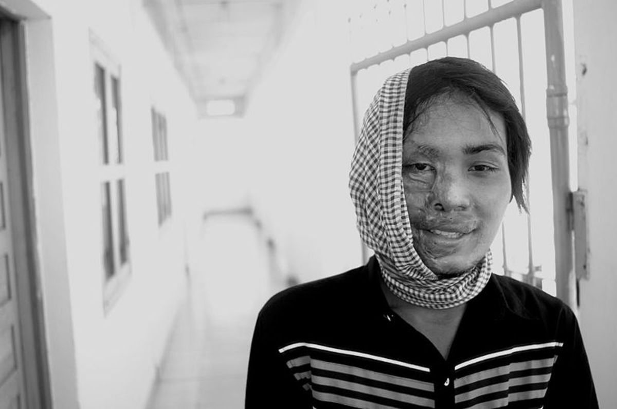 This Cambodian women was the victim of a brutal acid attack by a man. Today, sexual or gender inequality, despite the success of the feminist movement, is still a major problem in our society.