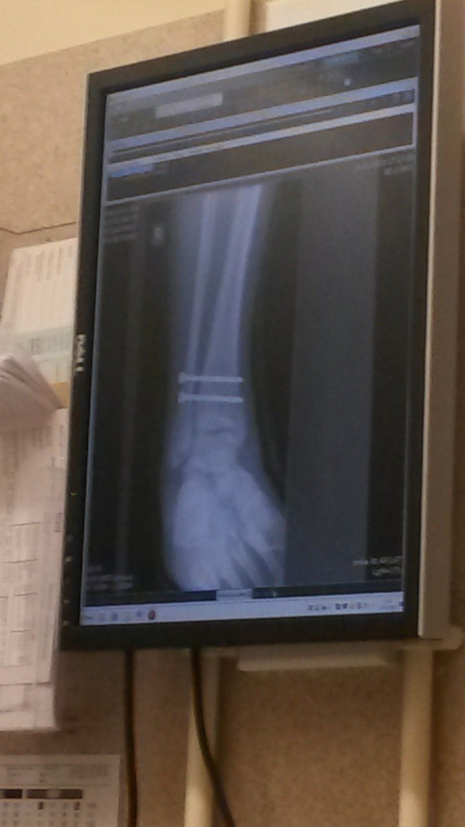An x-ray of my leg in early January 2015. A fractured tibia and fibula meant two pins and an open reduction internal fixation (ORIF) surgery.