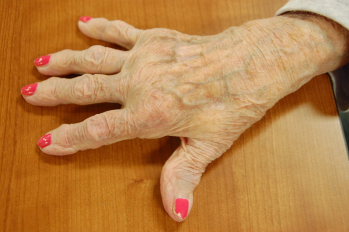 Arthritic hand 