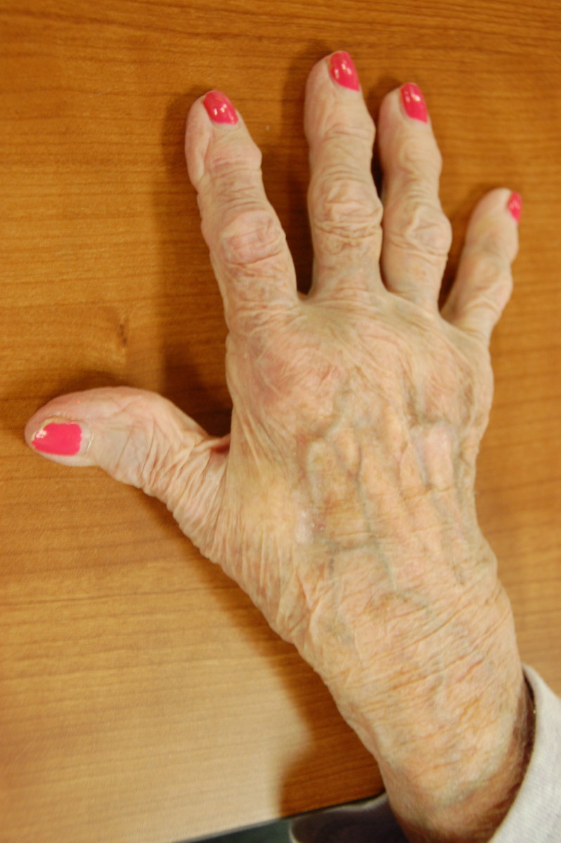 Heat Treatment Options to Relieve Arthritis Pain