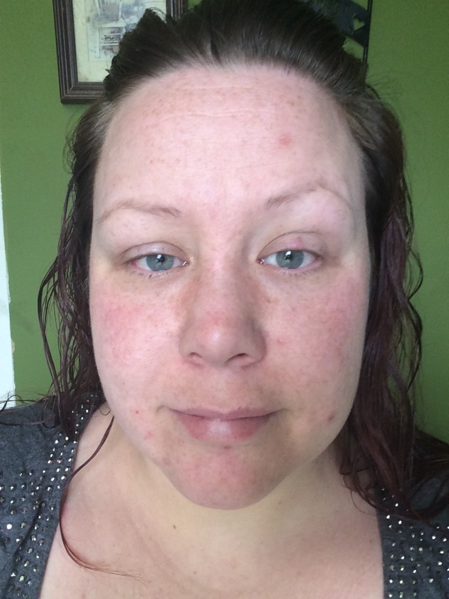 After using the facial mask I noticed than my acne scars appeared more predominant and red instead of any improvements.