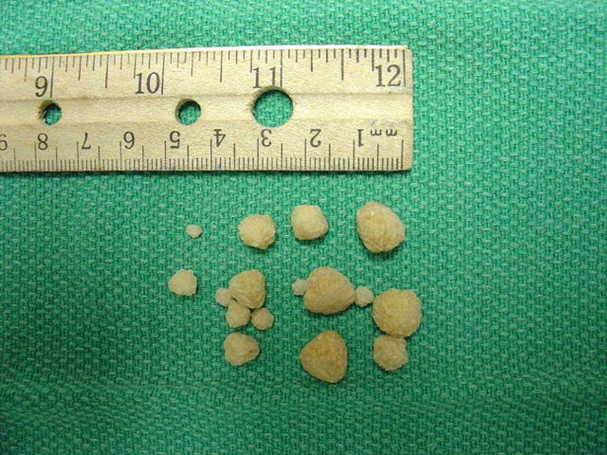 Oxalate stones from dog bladder