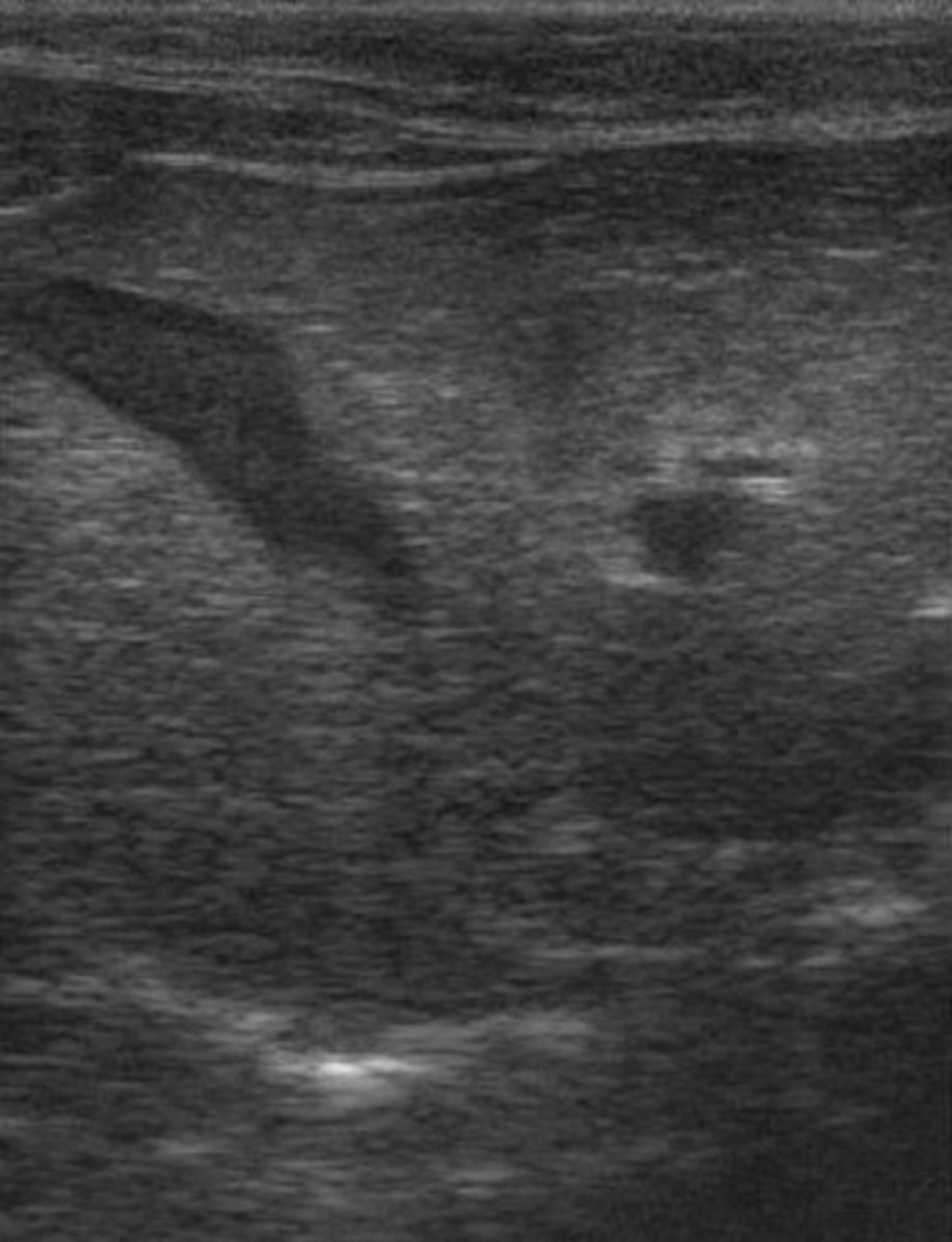 Sonograph of severe hepatic lipidosis in a cat. Note the increased echogenicity of the liver parenchyma, similar to the fatty tissue surrounding the liver.