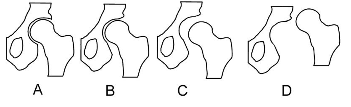 Schematic depiction of hip joint structures' positions in hip dysplasia by Londenp
