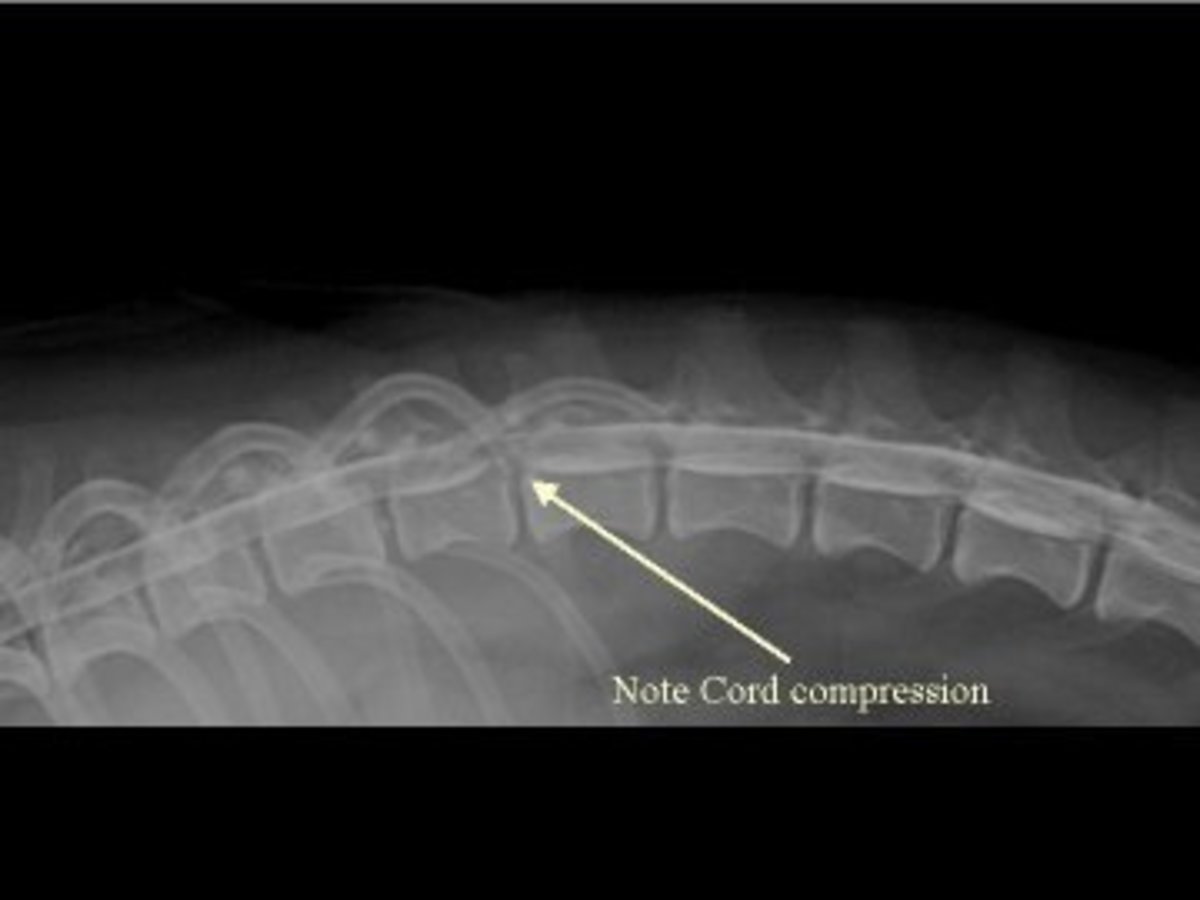 Spinal cord compression caused by the ruptured intervertebral
disc.