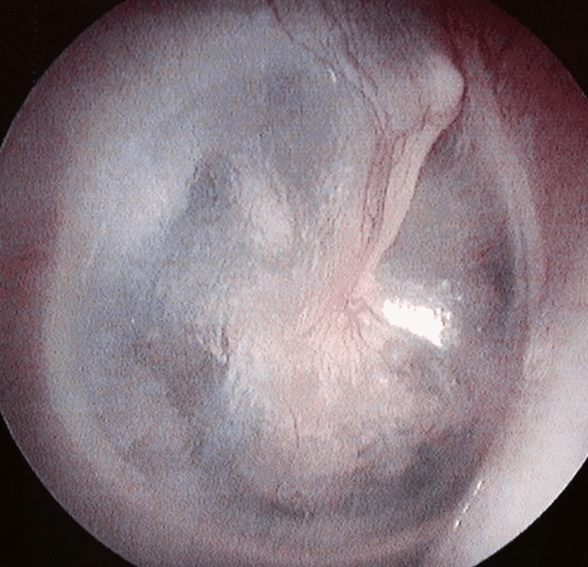 An example of an intact ear drum.