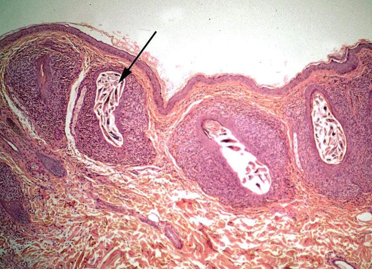 Demodex mites infesting hair follicles within the skin of their host, causing infiltration of inflammatory cells around the follicles.