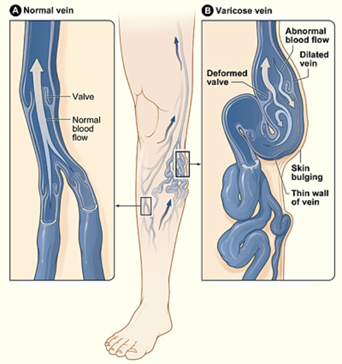 Varicose veins are painful and hamper blood circulation. 