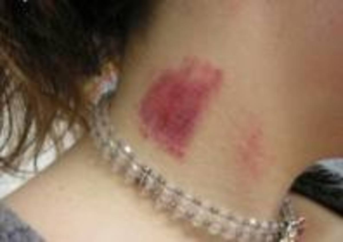 Hickies out to how take How To