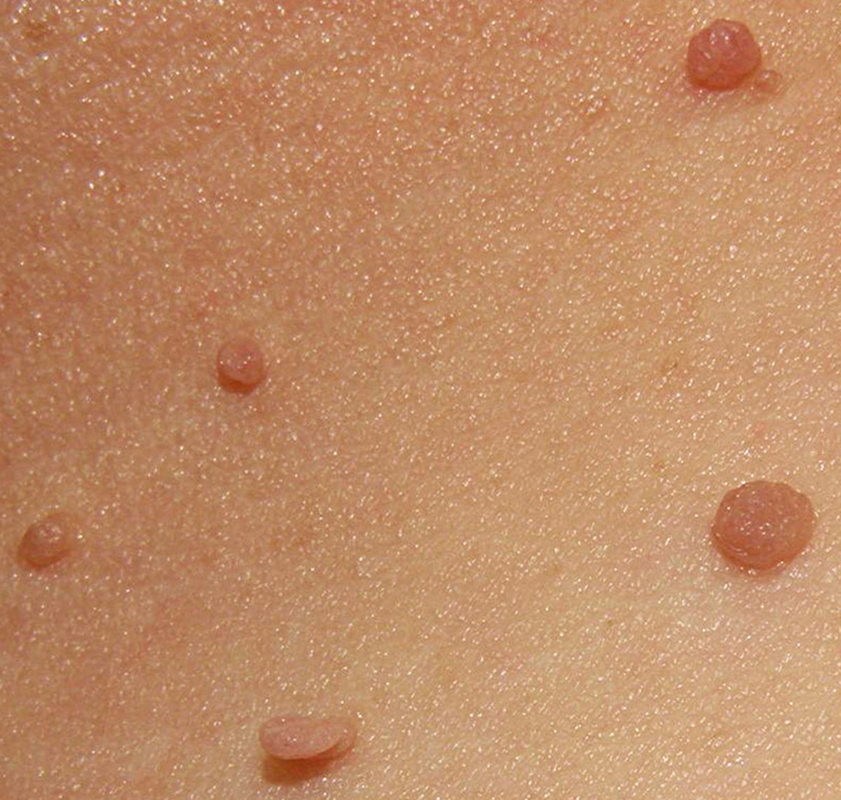 Harmless skin tags. Once they might have been designated as a witch's teats, where her familiars fed.