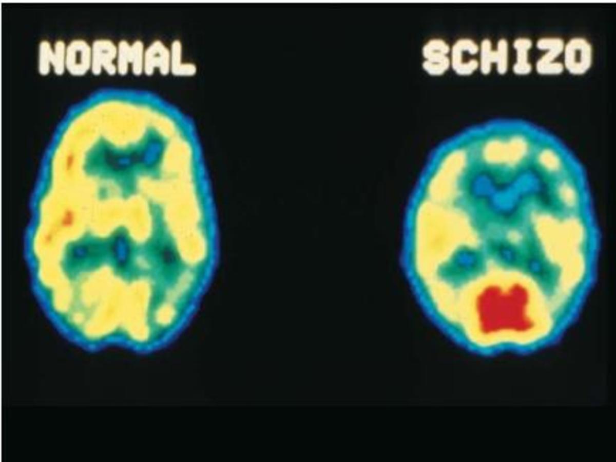 A comparison of a neurotypical brain and a schizophrenic brain