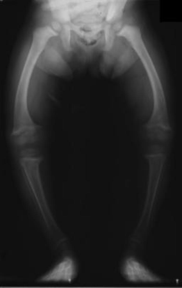 An x-ray of a child with rickets.