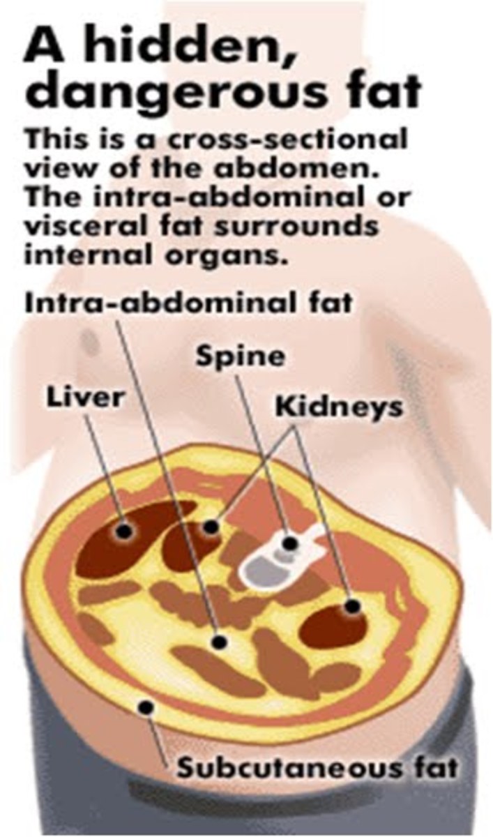 Visceral Fat in a Person with Potbelly