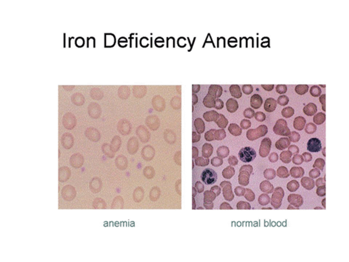 80% of the world’s population may be iron deficient