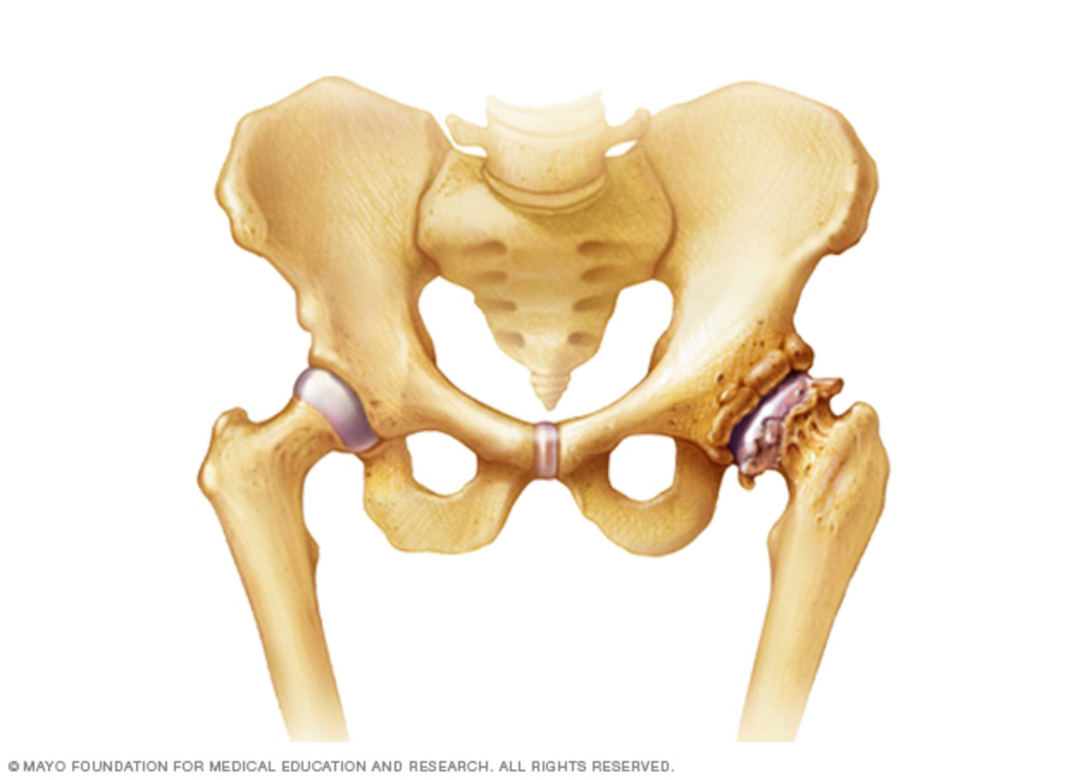 The hip joint shown on the left side of the image is normal, but the hip joint shown on the right side of the image shows deterioration of cartilage and the formation of bone spurs due to osteoarthritis.