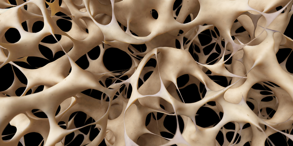 Osteoporosis Causes