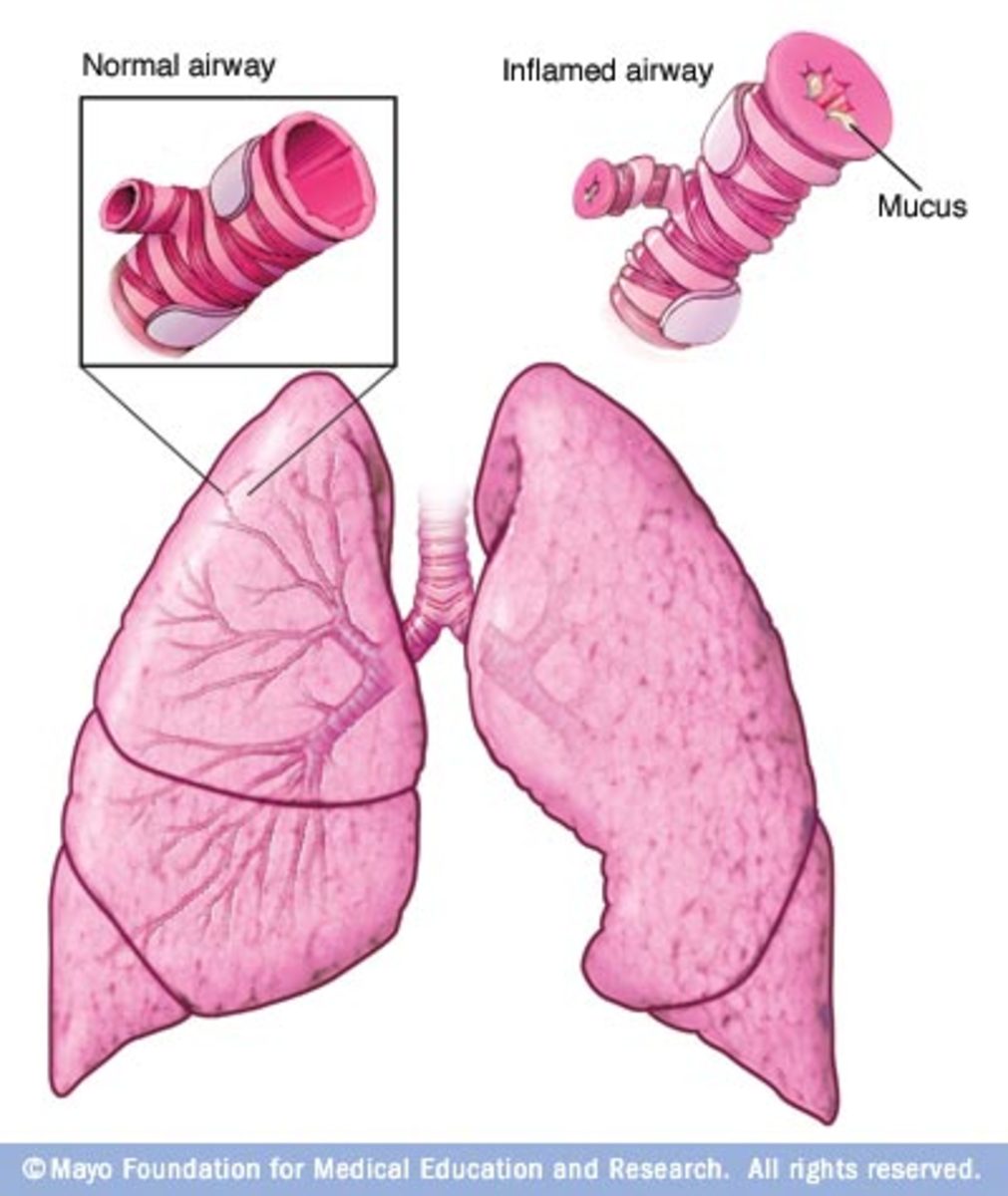 Asthma attack