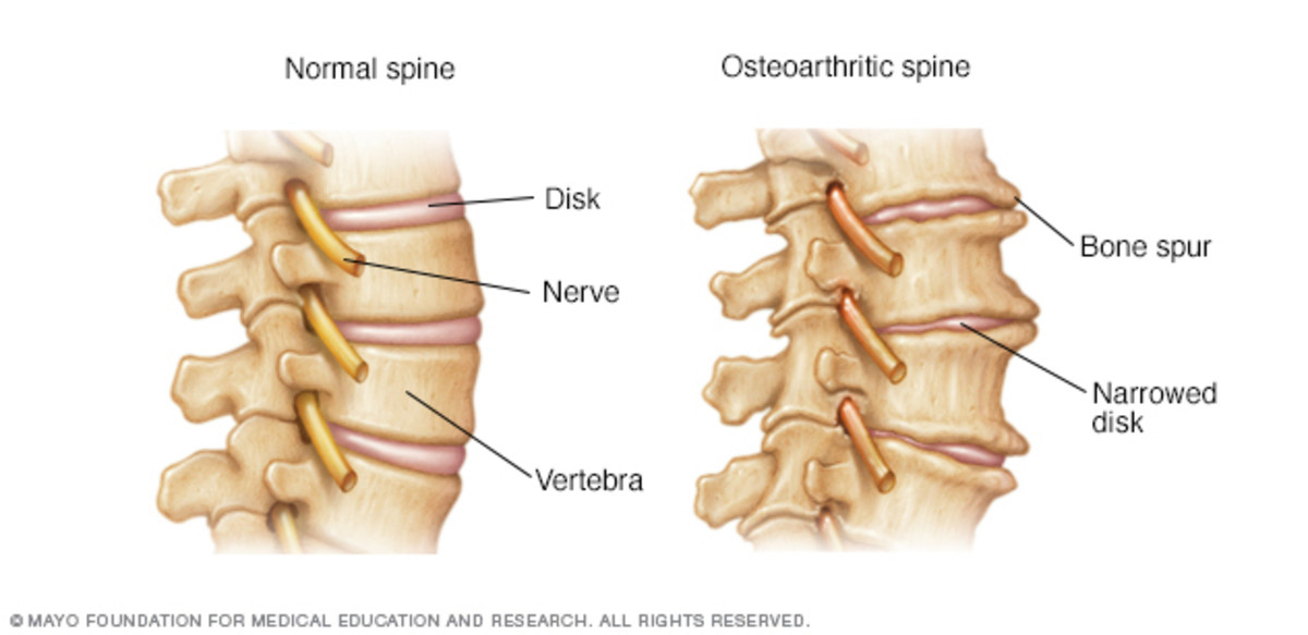 In osteoarthritis of the spine, disks narrow and bone spurs form. 