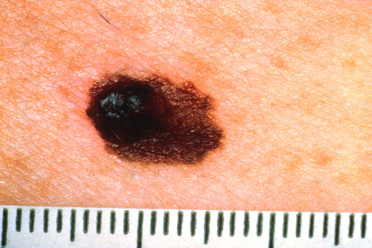 The ABCDE guide for self-check. A=ASYMMETRY: 1/2 of a mole or birthmark does not match the other 1/2