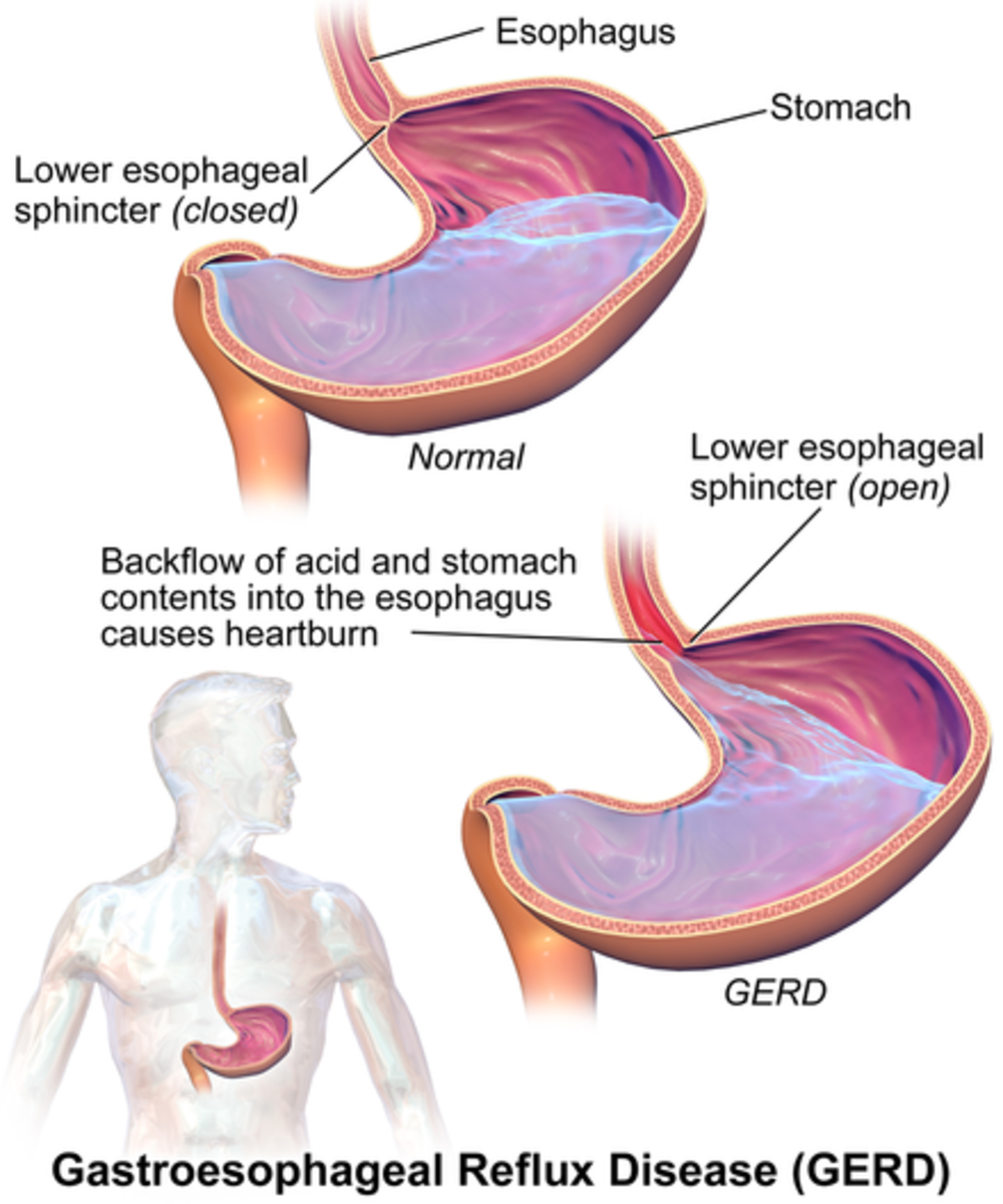 gastroesophageal-reflux-disease-gerd-facts