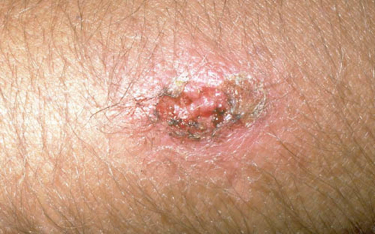 mrsa-warning-signs-and-preventive-measures