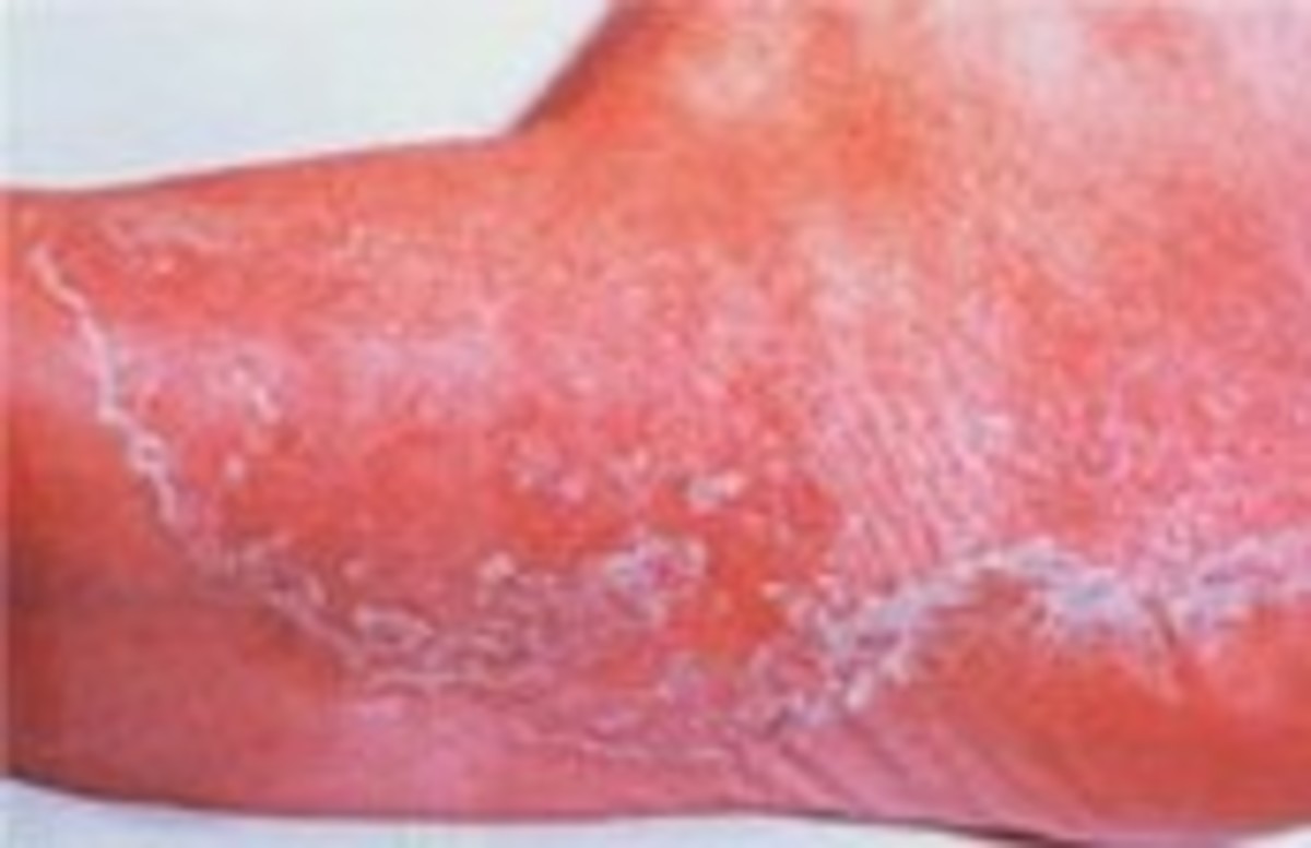 Ringworm Treatment - your free guide to real help - HubPages