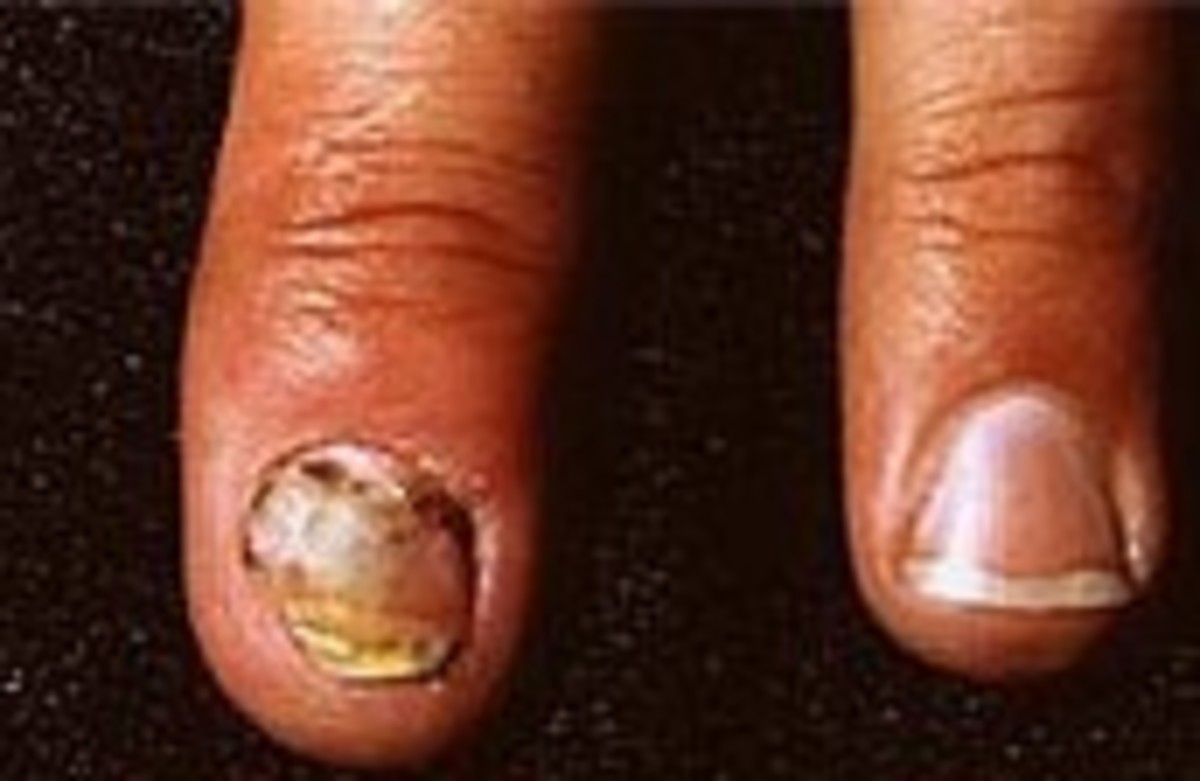 Ringworm Treatment your free guide to real help HubPages