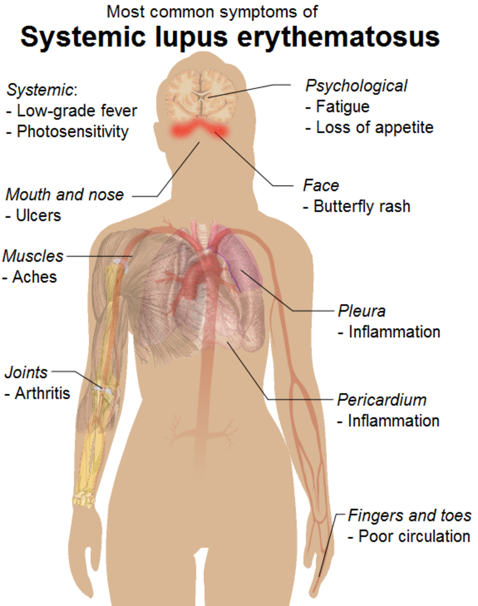 Common signs and symptoms of systemic lupus erythematosus.