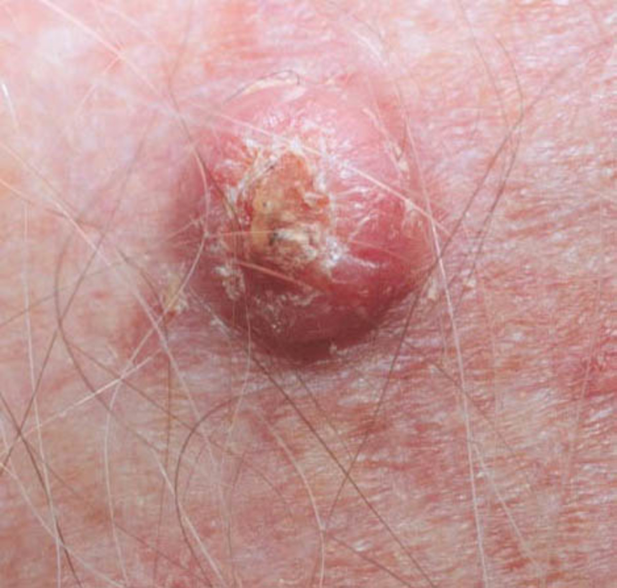skin-cancer-pictures