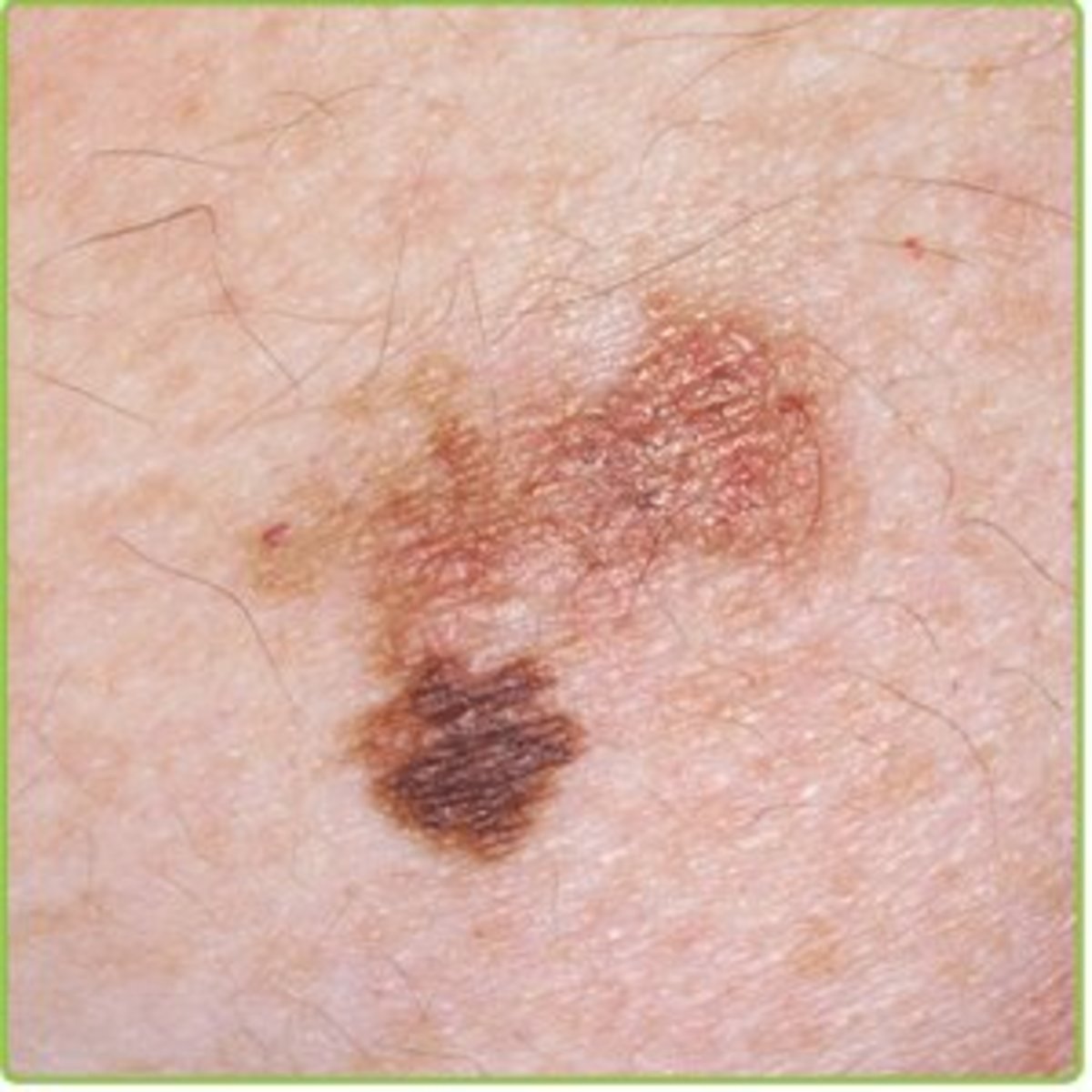 skin-cancer-pictures