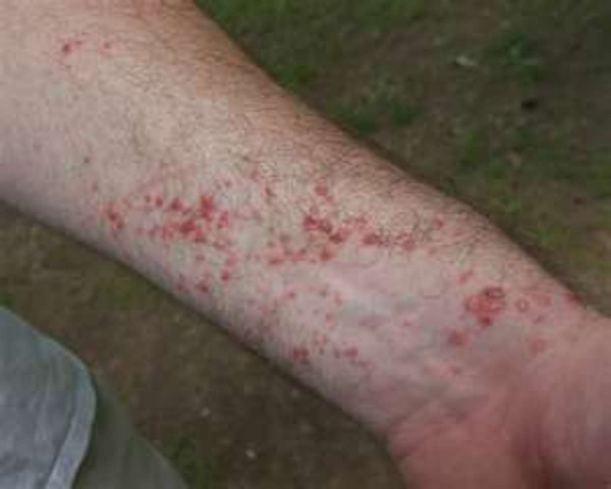 the-best-poison-ivy-poison-oak-sumac-and-bug-bite-cures