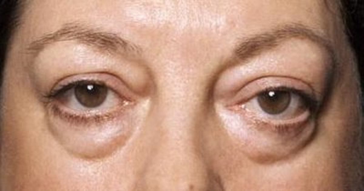Get Help for Those Baggy Bags Under Your Eyes