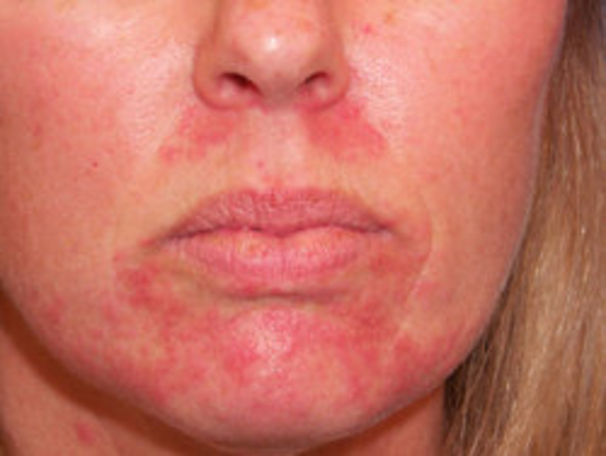 Cure Your Perioral Dermatitis