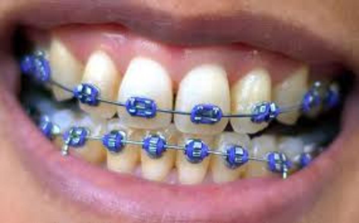 recipes-for-people-with-braces-recipes-for-after-mouth-surgery