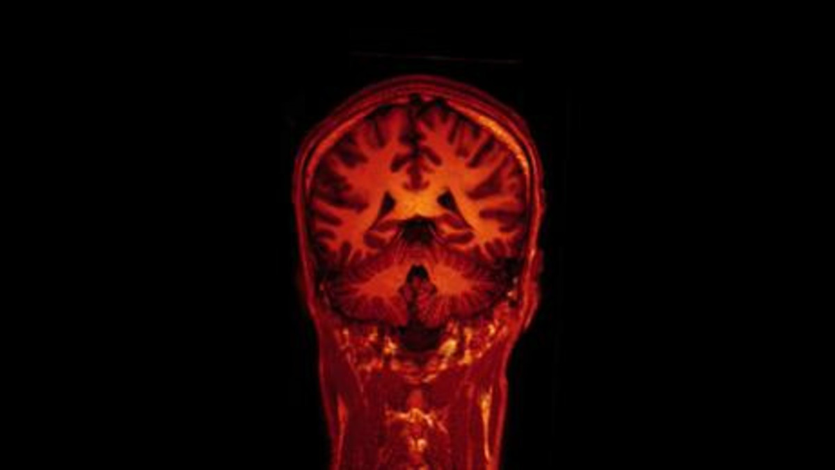 MRI Brain Scan