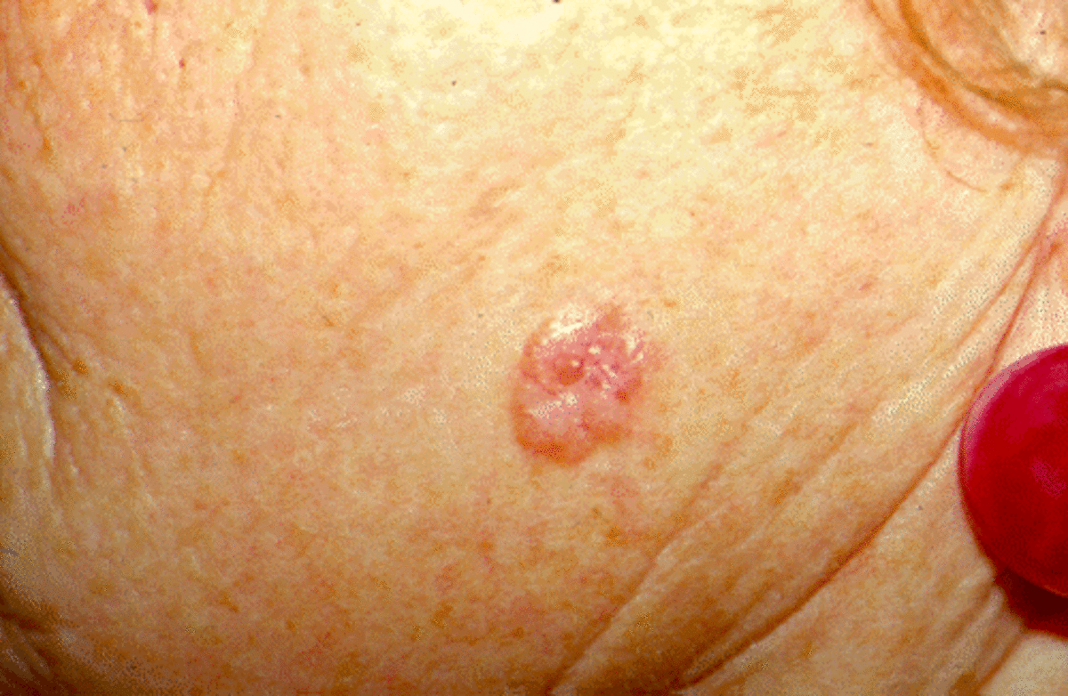 Skin Cancer Mohs Surgery