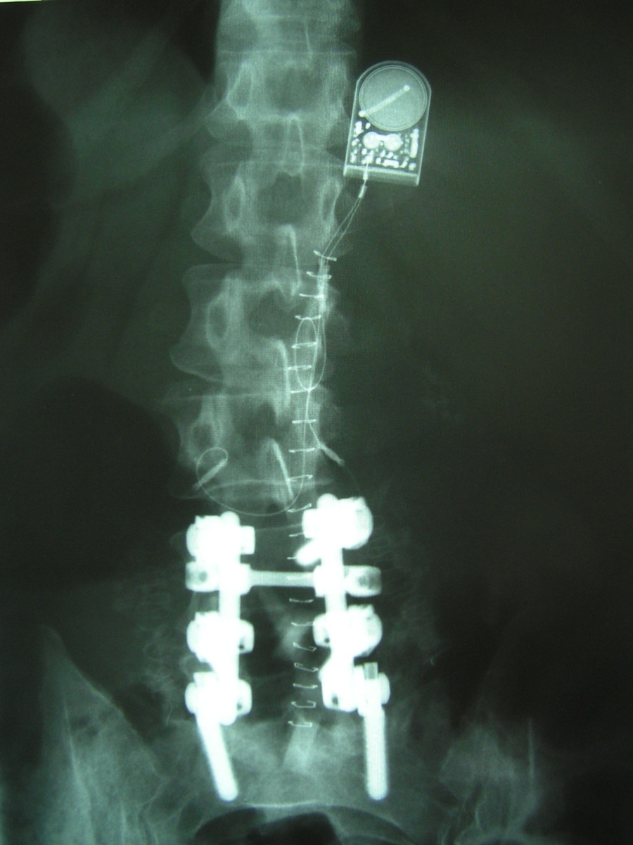 Spinal Arthritis can be debilitating.