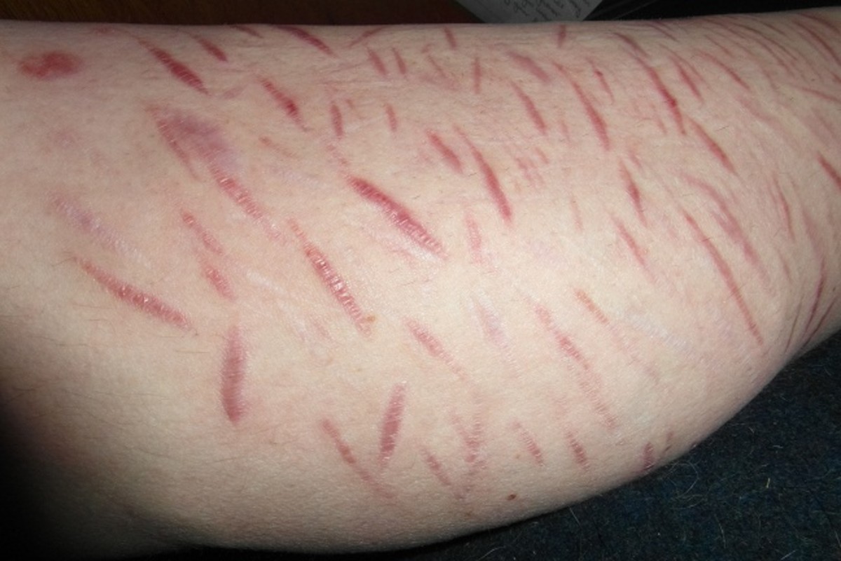 recent self harm scars on a leg