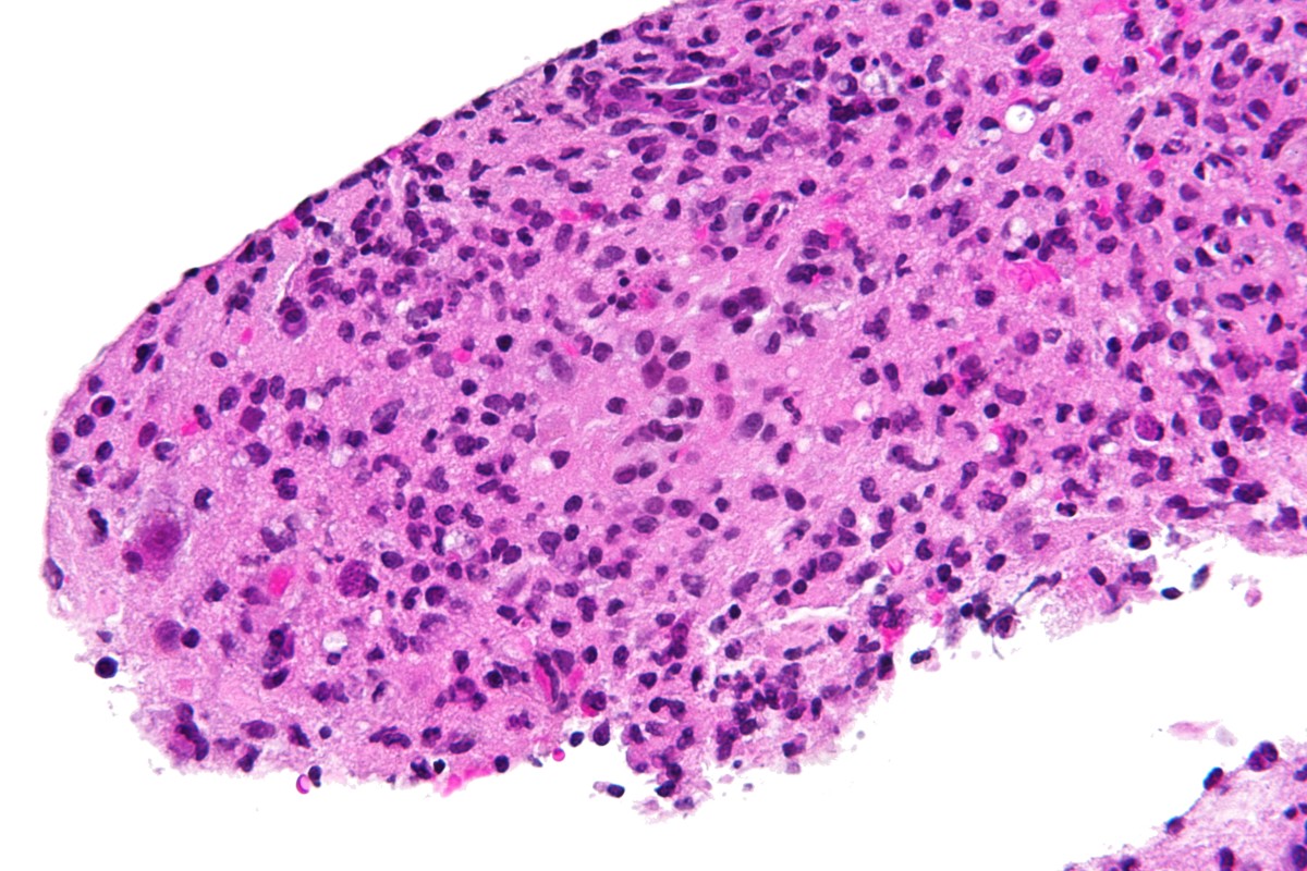 Toxoplasma gondii, as seen in a brain biopsy. This organism is found in soil and in cat litter, and can cause miscarriage or birth defects to a developing baby.