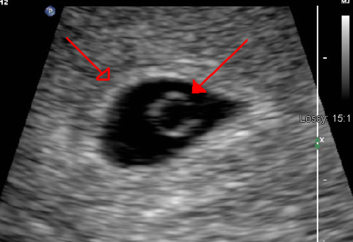 An ultrasound shows the "double ring" sign of a gestational sac and yolk sac. This is commonly seen on ultrasounds performed during the 5th week of pregnancy.
