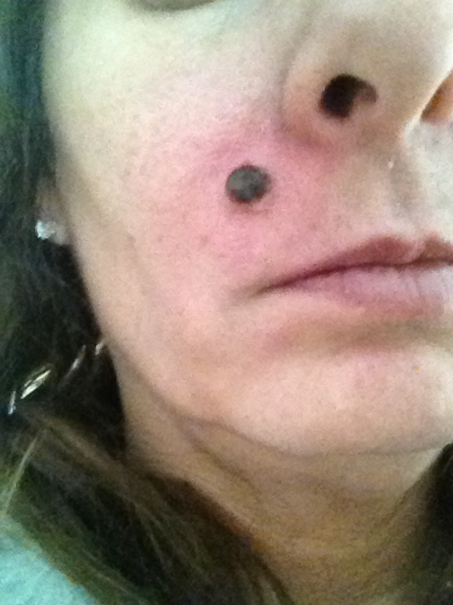 Day 2: The mole turns black.