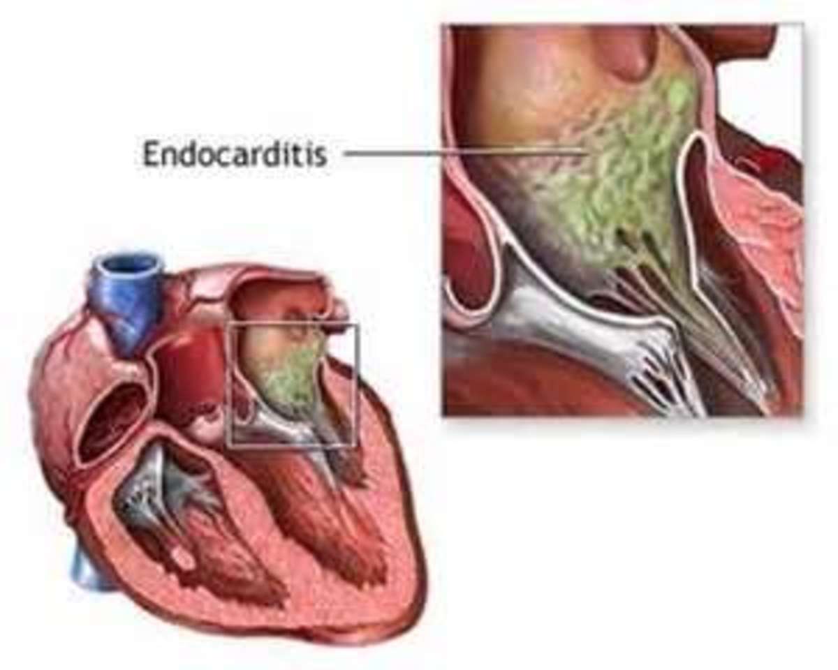 endocarditis infection