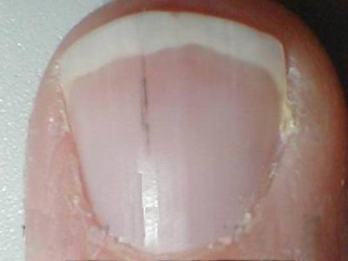 Splinter Fingernails - Curious symptom caused by a blow or possibly an indication of heart disease.