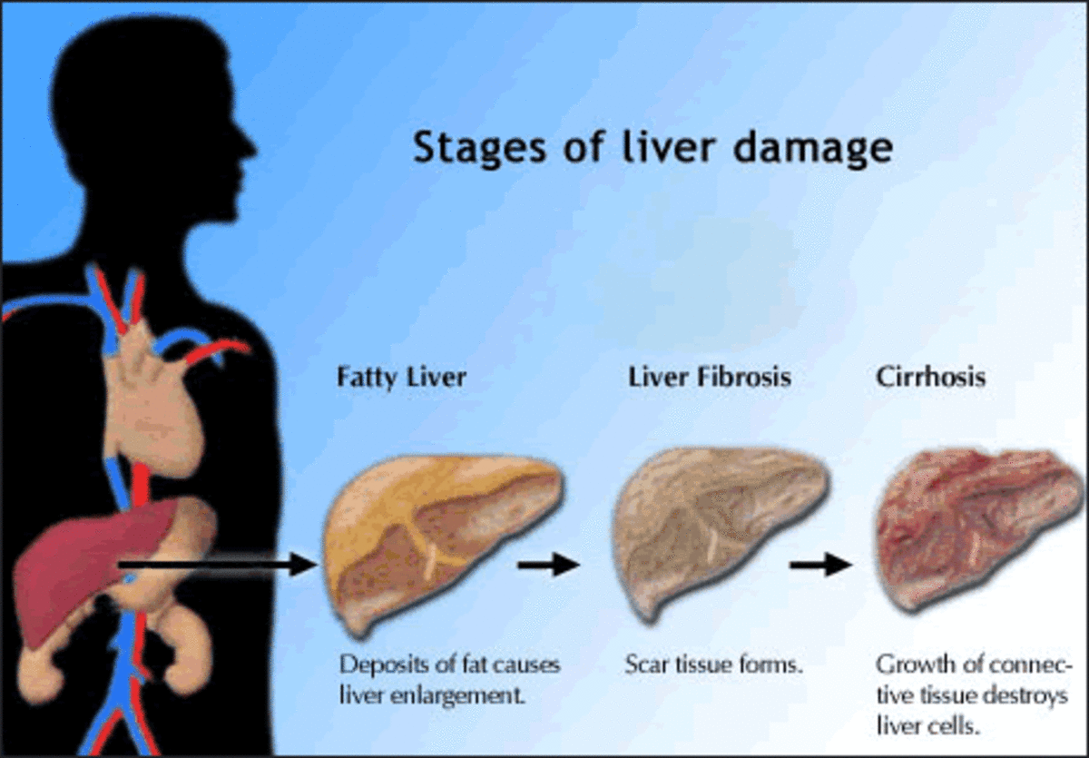 The different stages of liver damage