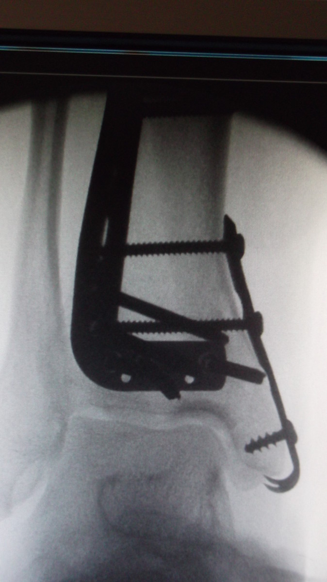 Thanks to the surgeons who inserted the plate and screws to repair my husband's broken ankle.