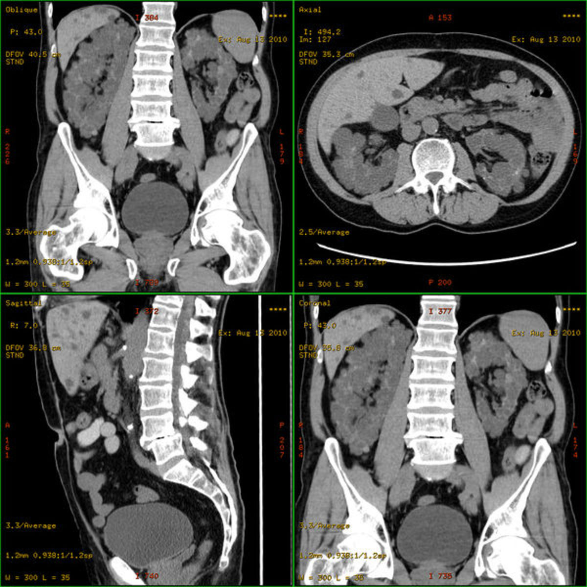 autosomal dominant polyzystic kidney disease, native CT scan Author: Hg6996